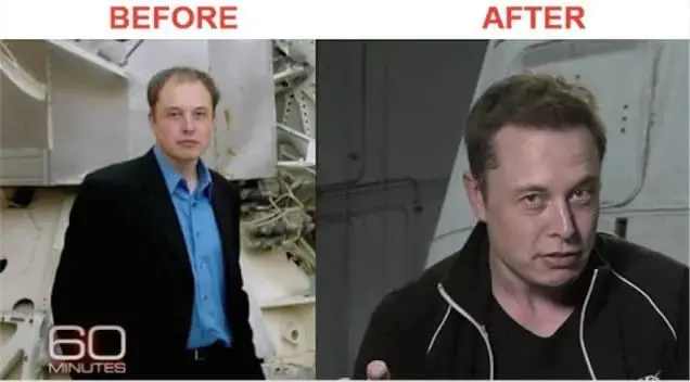 Elon Musk's Hair Transplant