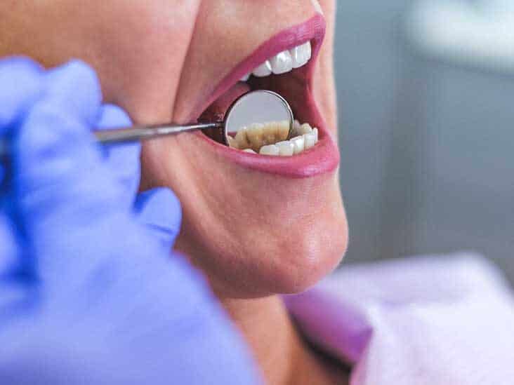 open-female-mouth-during-oral-checkup-at-the-dentist-selective
