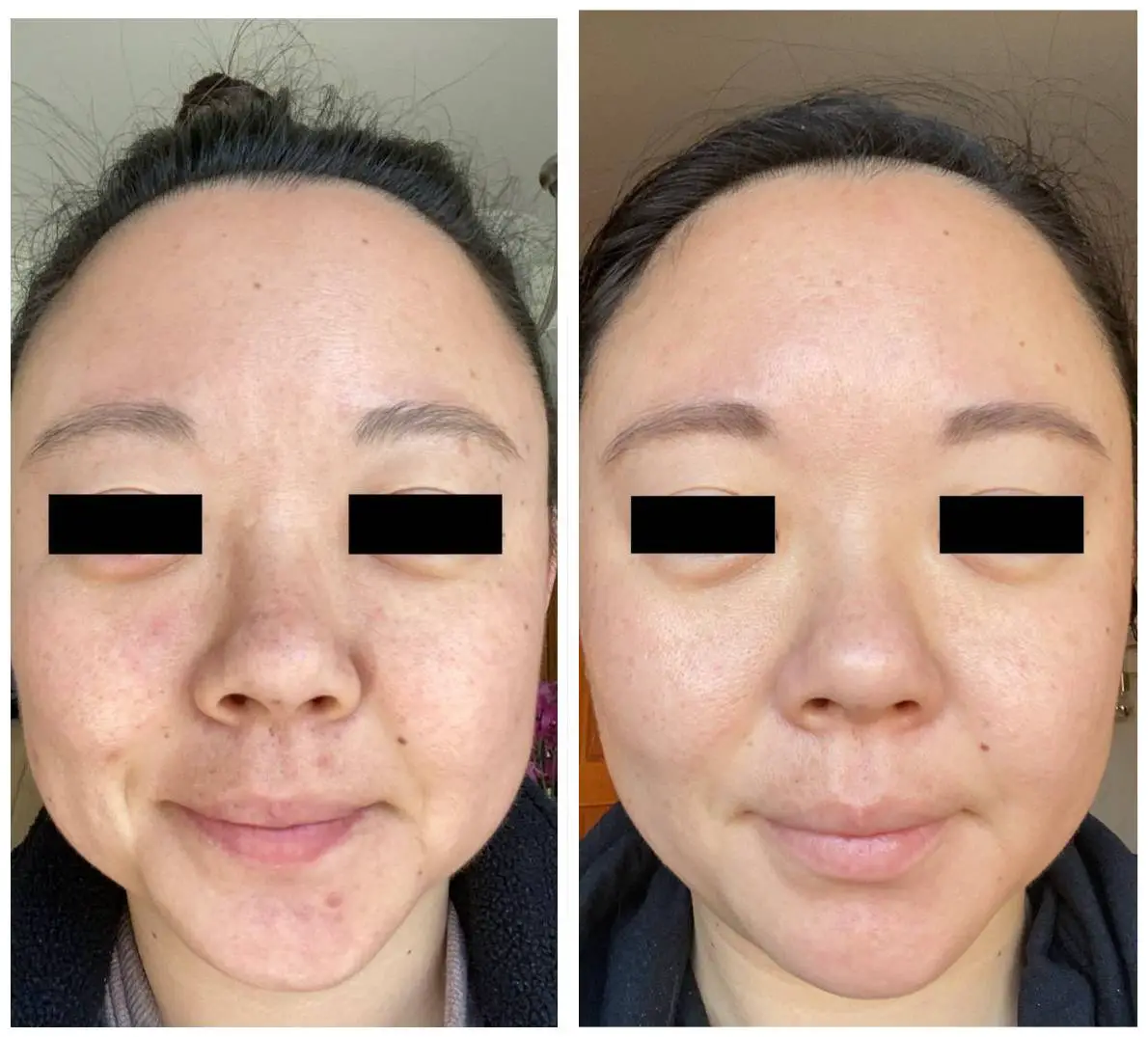 tretinoin before and after